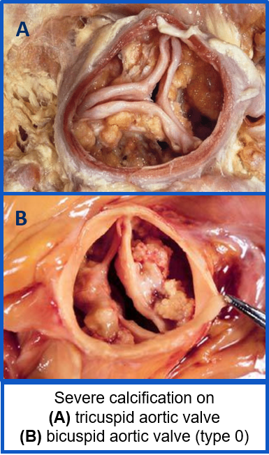 BAV anatomy